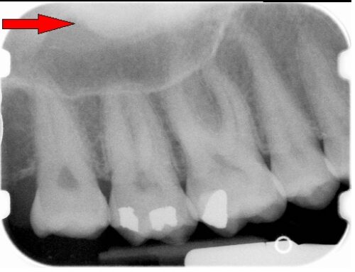 Sinus Problems? Check Your Teeth